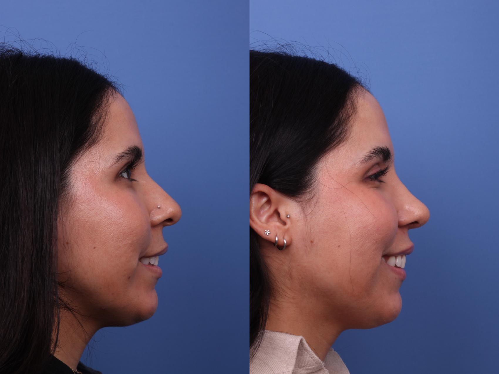 Before & After Rhinoplasty Case 576 Right Smile View in Scottsdale, AZ