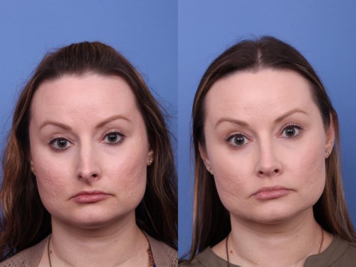 Rhinoplasty Before & After Photo | Scottsdale & Phoenix, AZ | Hobgood Facial Plastic Surgery: Todd Hobgood, MD