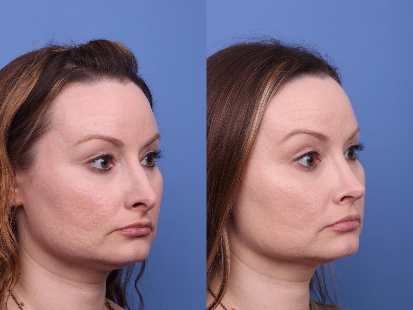 Before & After Rhinoplasty Case 577 Right Oblique View in Scottsdale, AZ