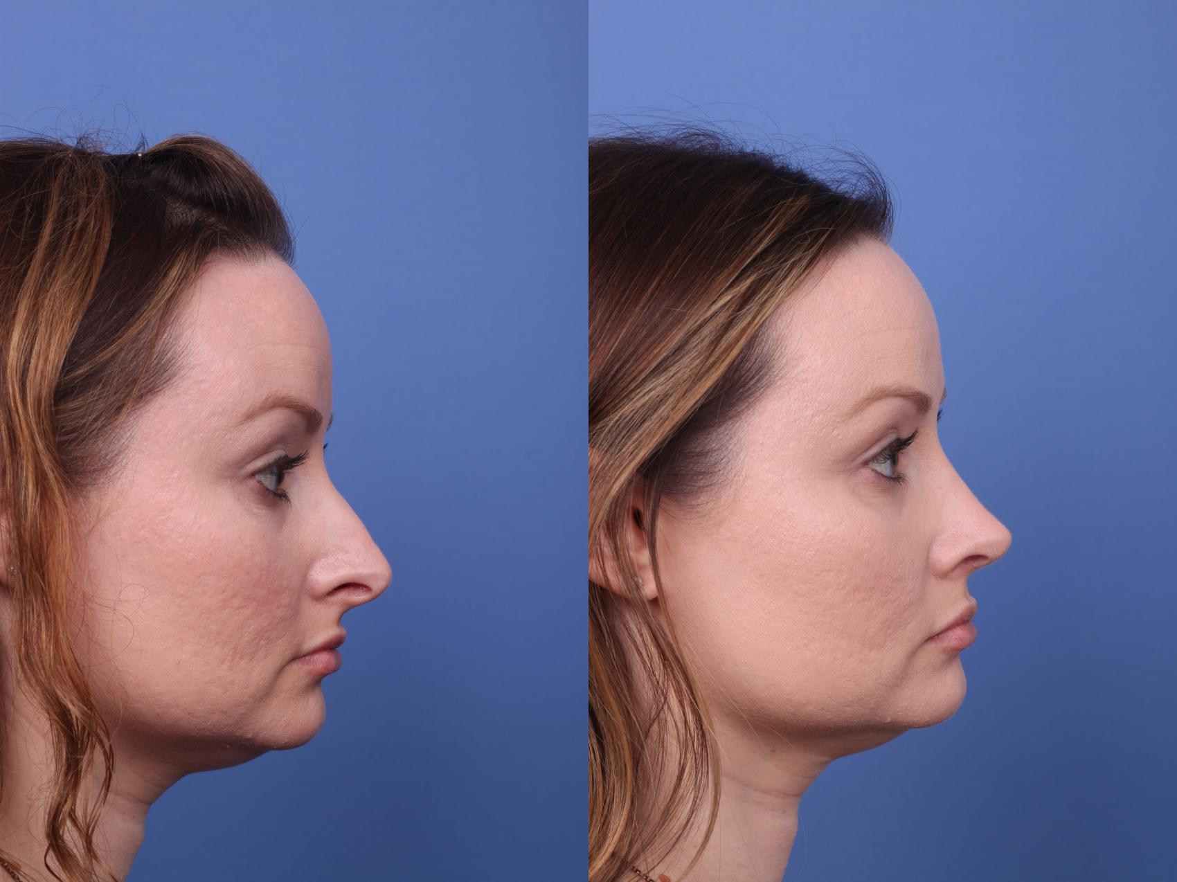 Before & After Rhinoplasty Case 577 Right Side View in Scottsdale, AZ