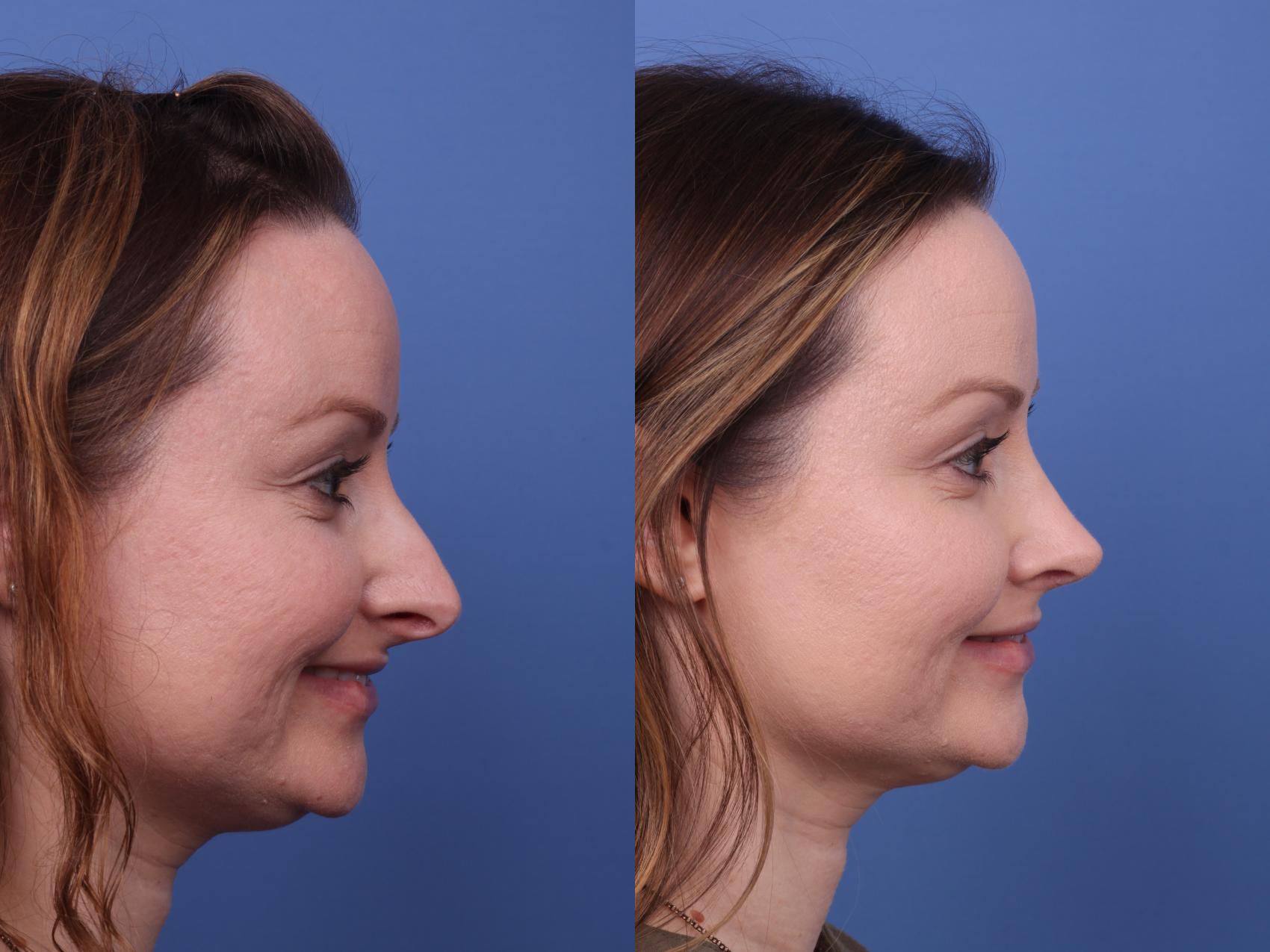 Before & After Rhinoplasty Case 577 Right Smile View in Scottsdale, AZ