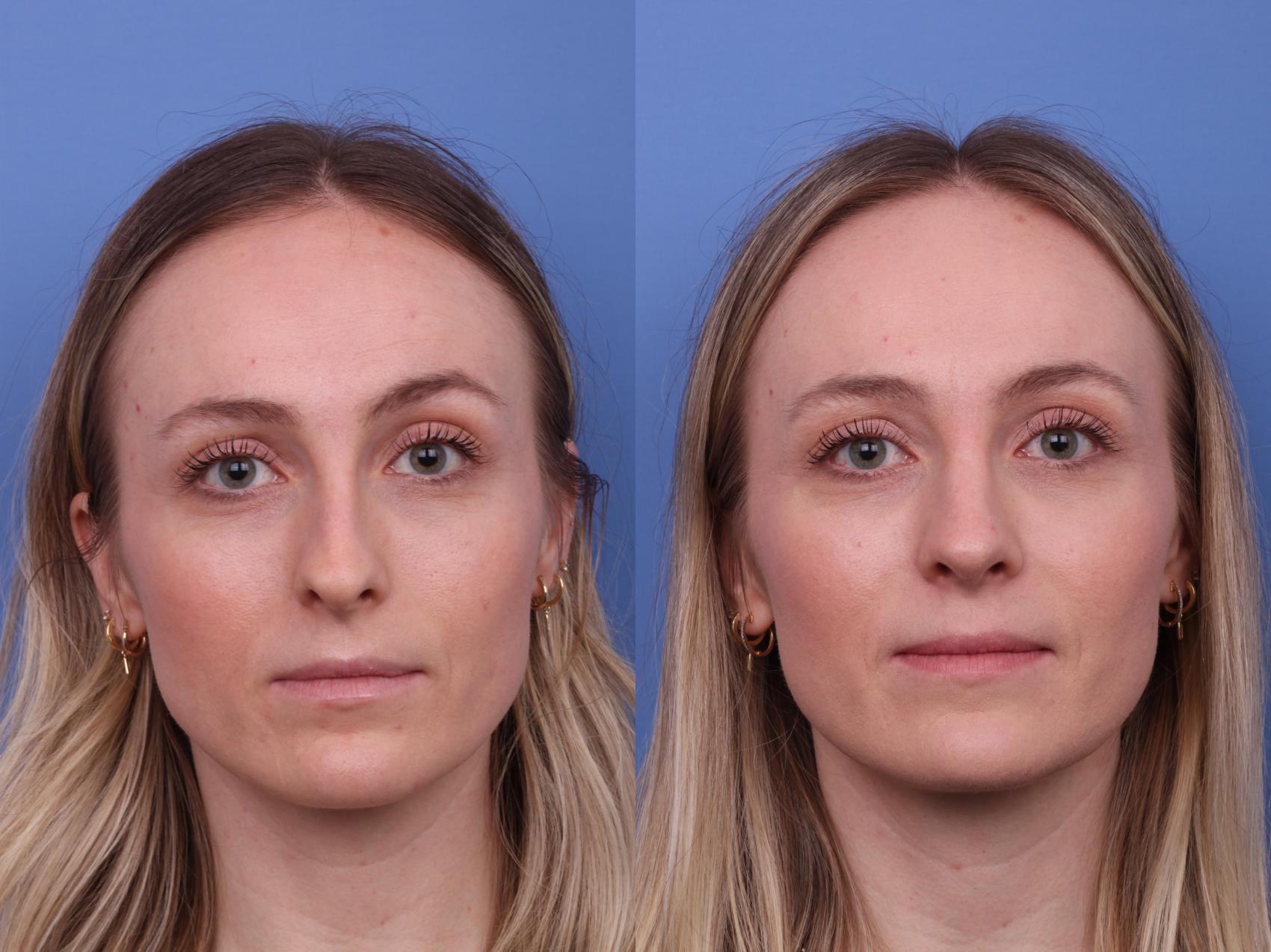 Rhinoplasty Before & After Photo | Scottsdale & Phoenix, AZ | Hobgood Facial Plastic Surgery: Todd Hobgood, MD