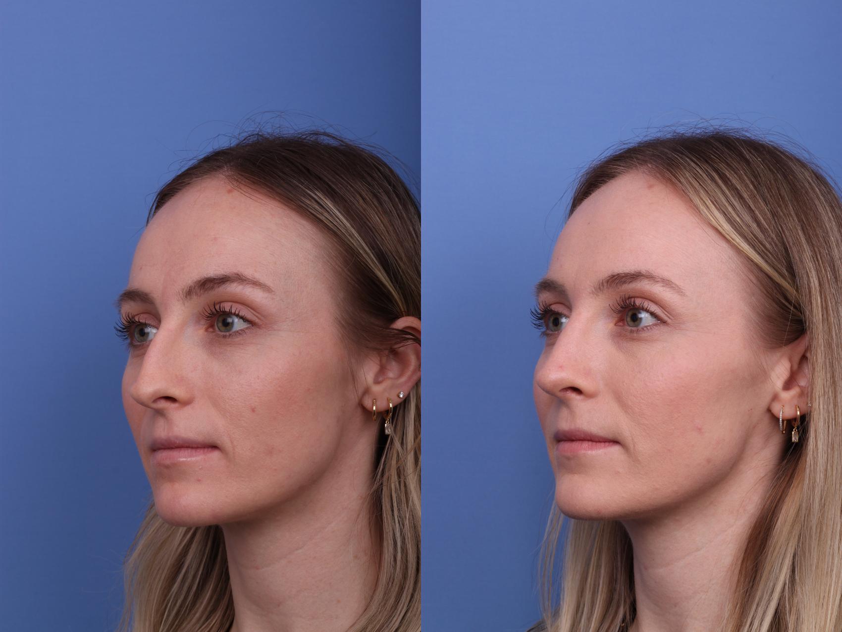 Before & After Rhinoplasty Case 578 Left Oblique View in Scottsdale, AZ