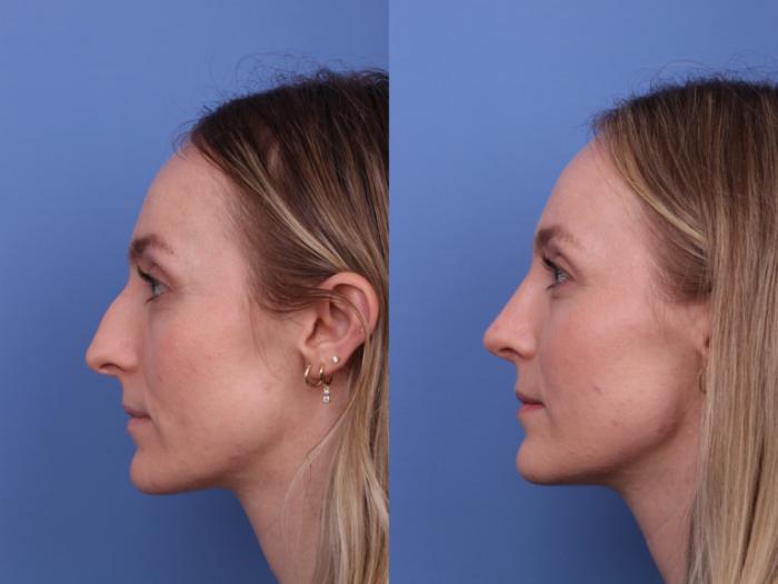 Rhinoplasty Before & After Photo | Scottsdale & Phoenix, AZ | Hobgood Facial Plastic Surgery: Todd Hobgood, MD