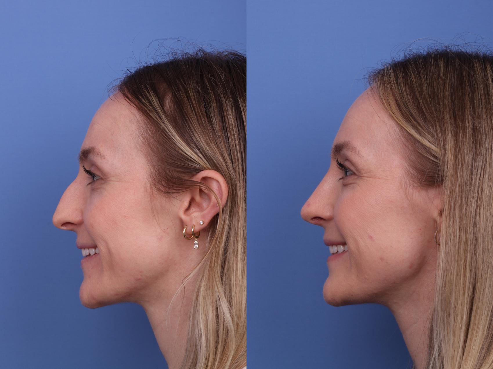 Before & After Rhinoplasty Case 578 Left Smile View in Scottsdale, AZ