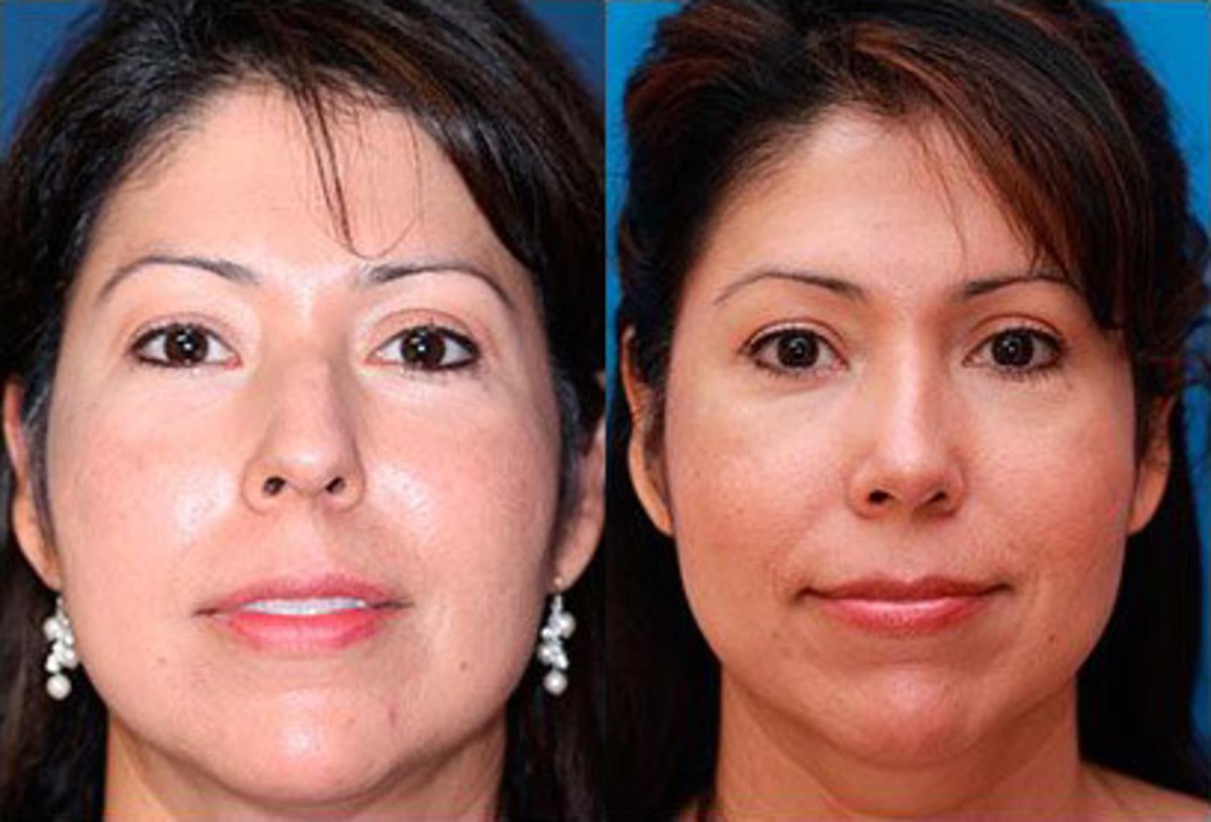 Before & After Rhinoplasty Case 58 View #2 View in Scottsdale, AZ