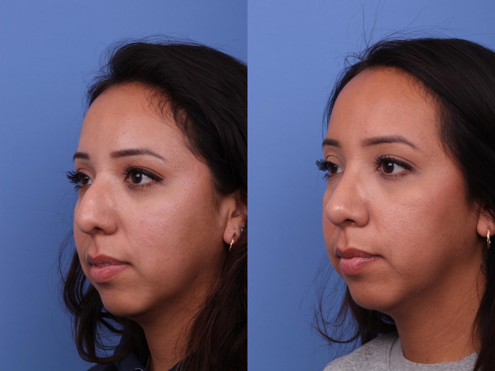 Before & After Ethnic Rhinoplasty Case 580 Left Oblique View in Scottsdale, AZ