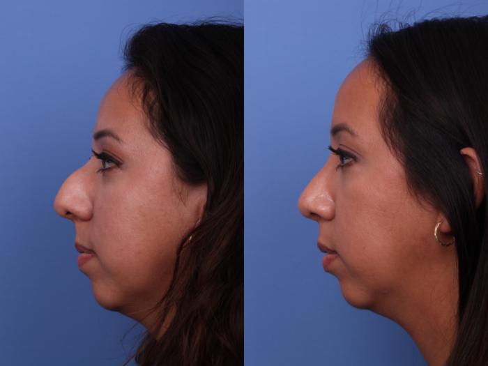 Rhinoplasty Before & After Photo | Scottsdale & Phoenix, AZ | Hobgood Facial Plastic Surgery: Todd Hobgood, MD