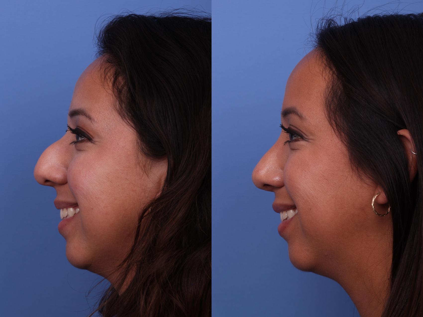 Before & After Ethnic Rhinoplasty Case 580 Left Smile View in Scottsdale, AZ
