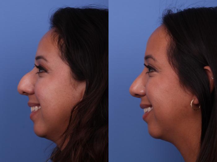 Rhinoplasty Before & After Photo | Scottsdale & Phoenix, AZ | Hobgood Facial Plastic Surgery: Todd Hobgood, MD