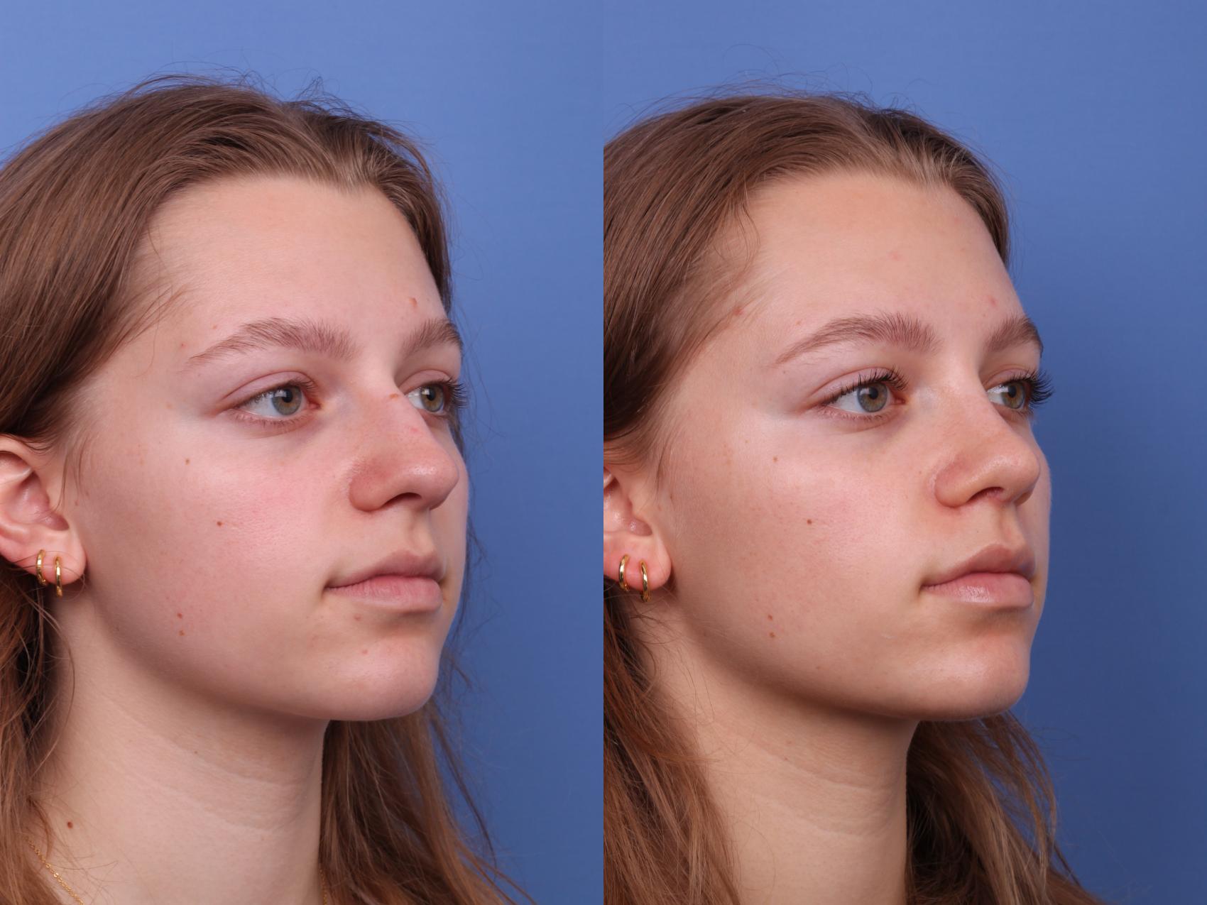 Rhinoplasty Before & After Photo | Scottsdale & Phoenix, AZ | Hobgood Facial Plastic Surgery: Todd Hobgood, MD