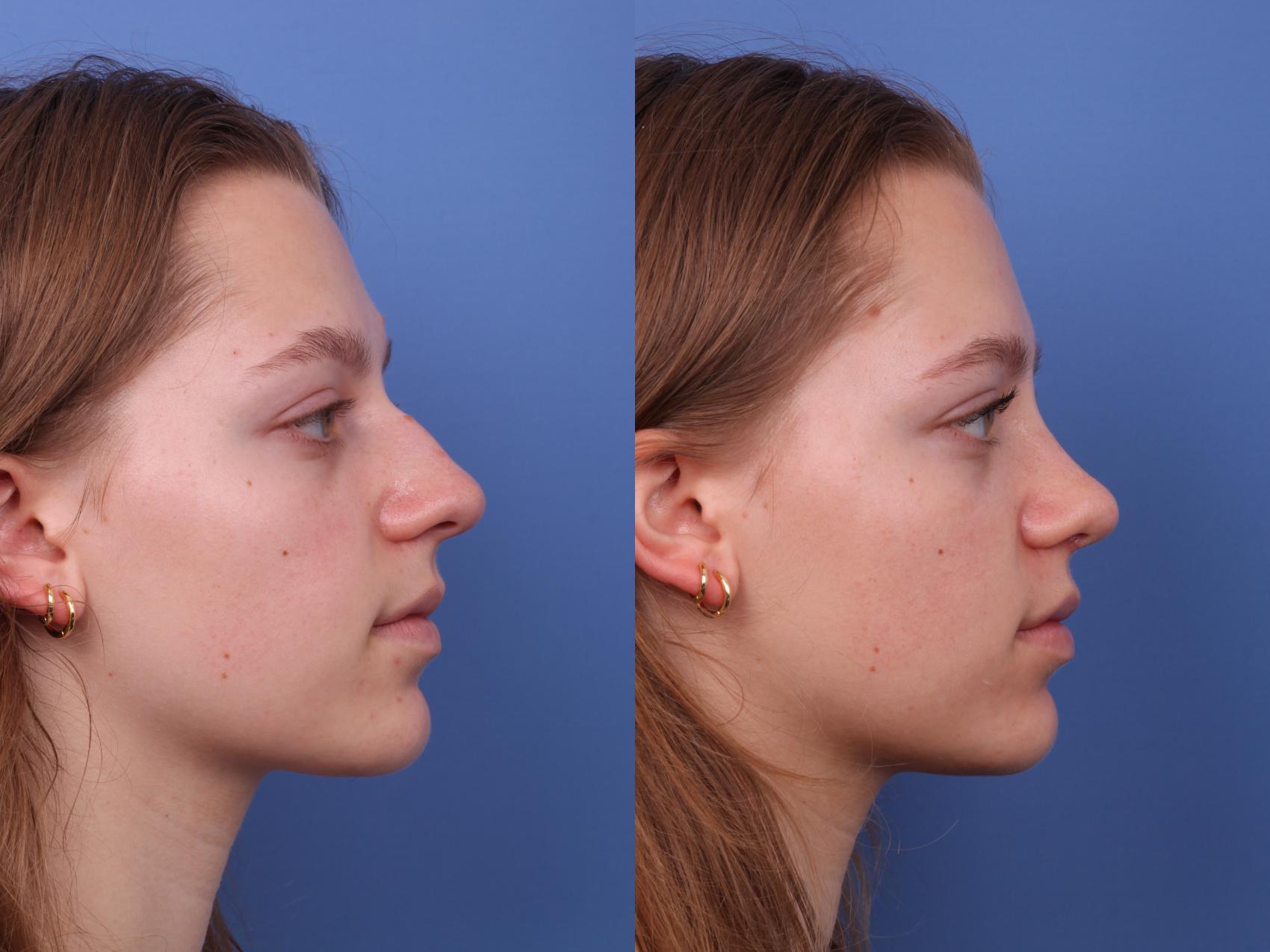 Before & After Rhinoplasty Case 581 Right Side View in Scottsdale, AZ