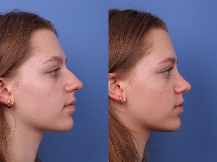 Rhinoplasty Before & After Photo | Scottsdale & Phoenix, AZ | Hobgood Facial Plastic Surgery: Todd Hobgood, MD