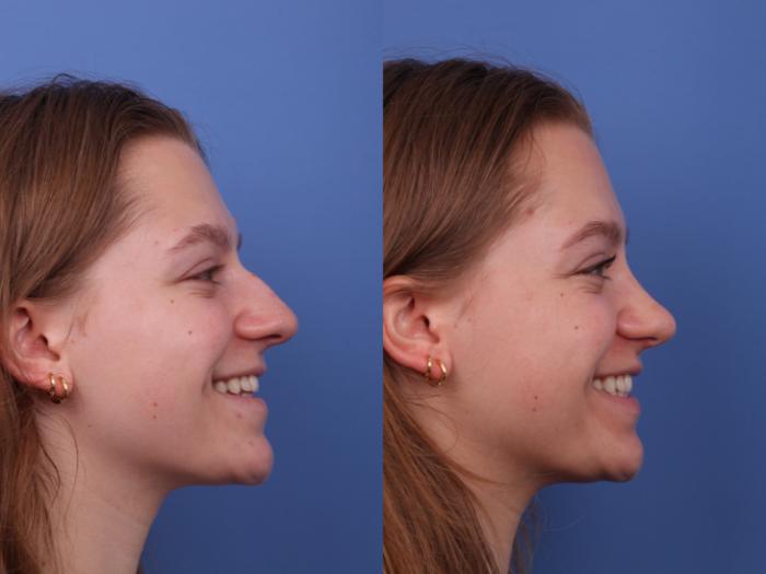 Rhinoplasty Before & After Photo | Scottsdale & Phoenix, AZ | Hobgood Facial Plastic Surgery: Todd Hobgood, MD