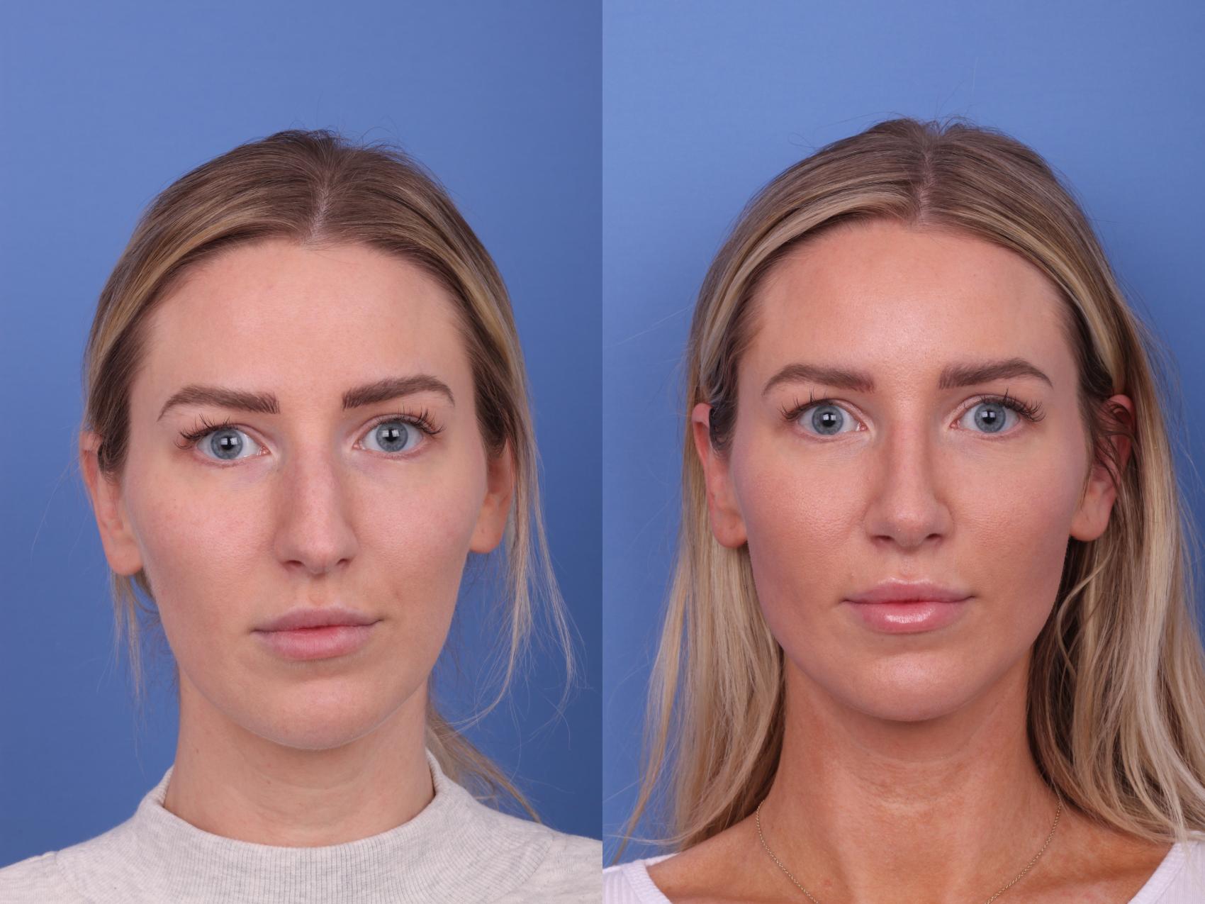 Rhinoplasty Before & After Photo | Scottsdale & Phoenix, AZ | Hobgood Facial Plastic Surgery: Todd Hobgood, MD