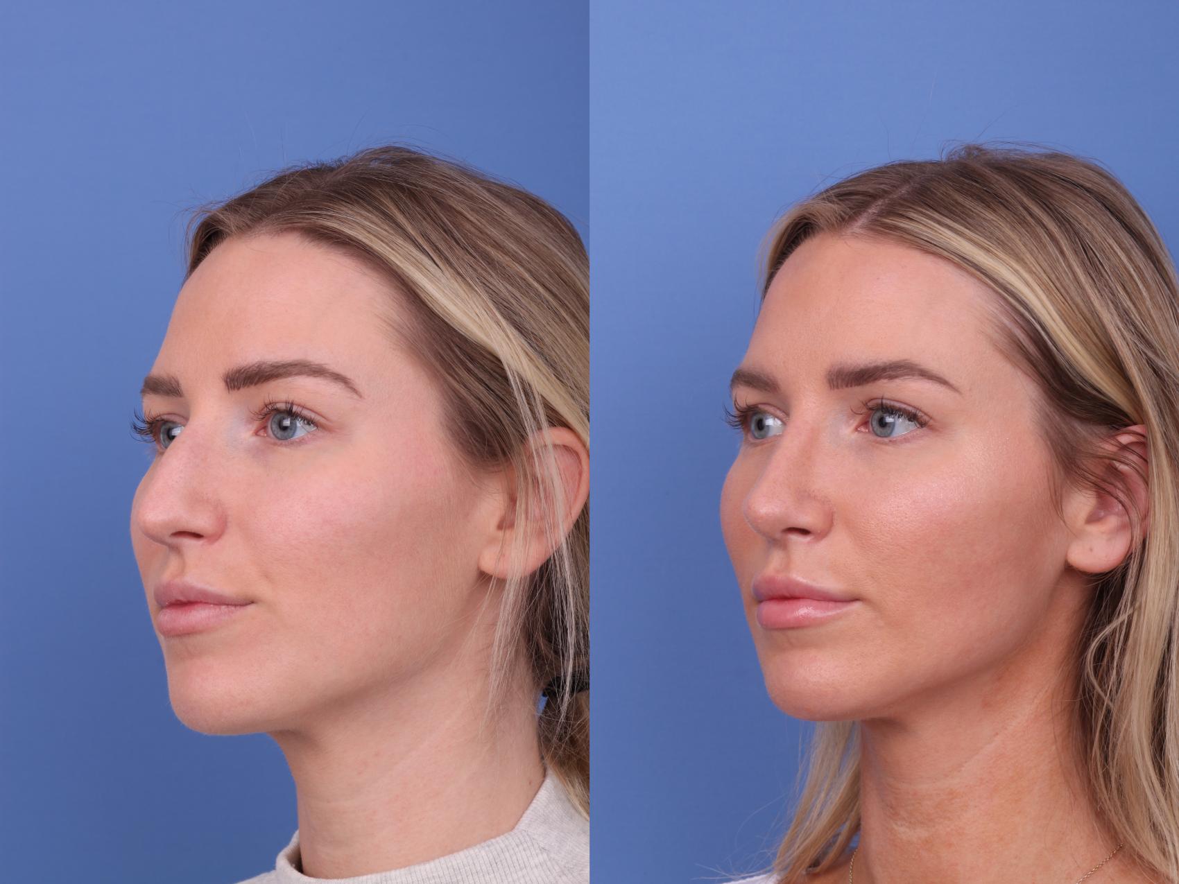 Before & After Rhinoplasty Case 582 Left Oblique View in Scottsdale, AZ