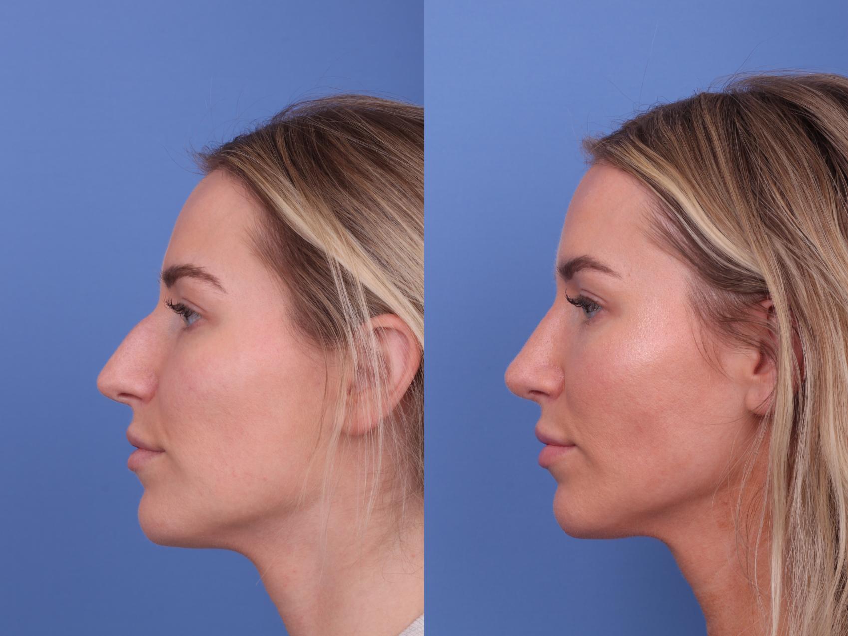 Before & After Rhinoplasty Case 582 Left Side View in Scottsdale, AZ