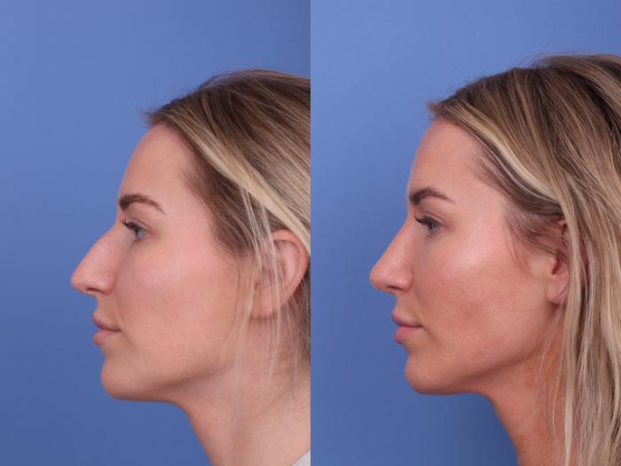 Rhinoplasty Before & After Photo | Scottsdale & Phoenix, AZ | Hobgood Facial Plastic Surgery: Todd Hobgood, MD