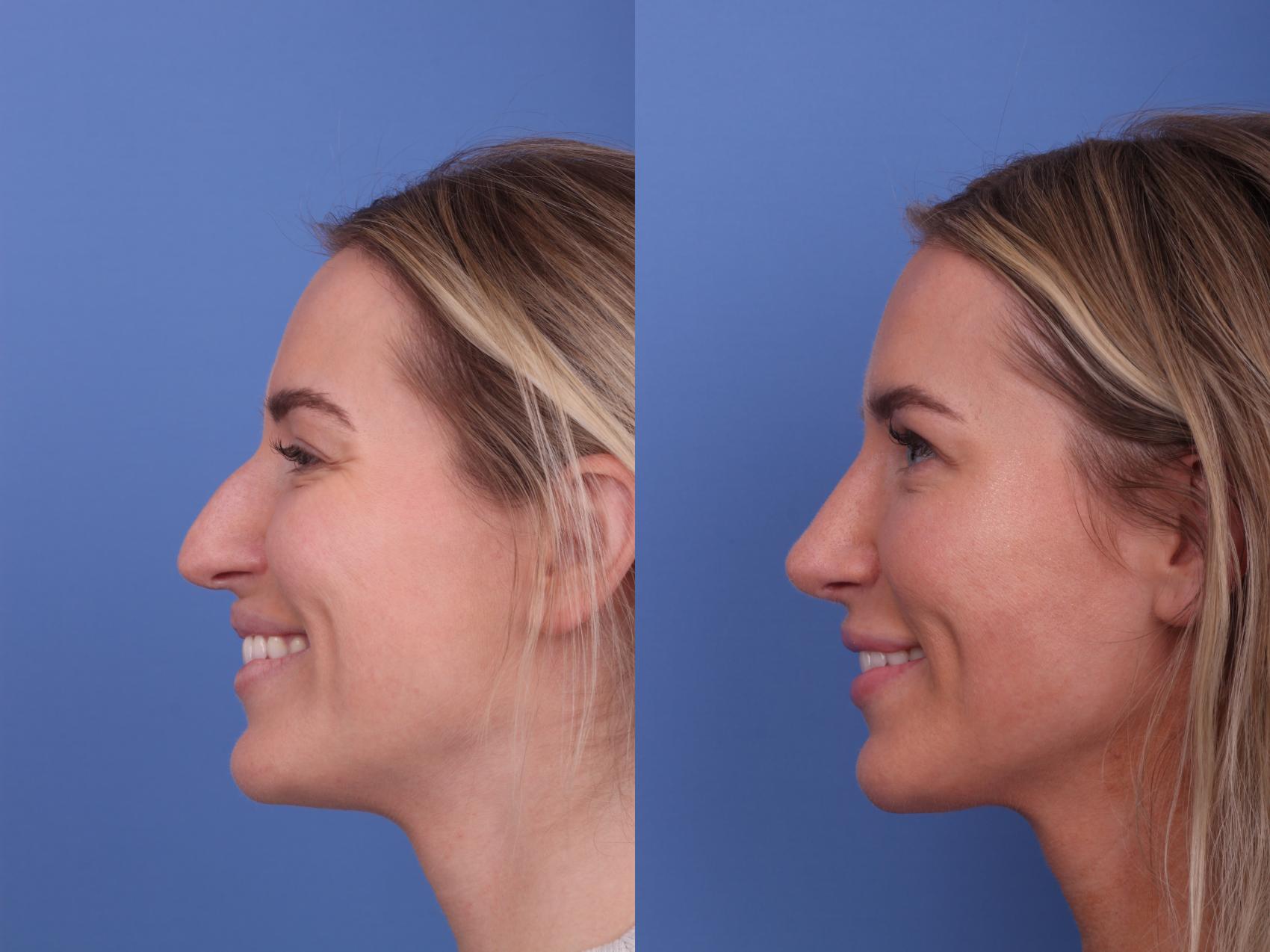 Before & After Rhinoplasty Case 582 Left Smile View in Scottsdale, AZ