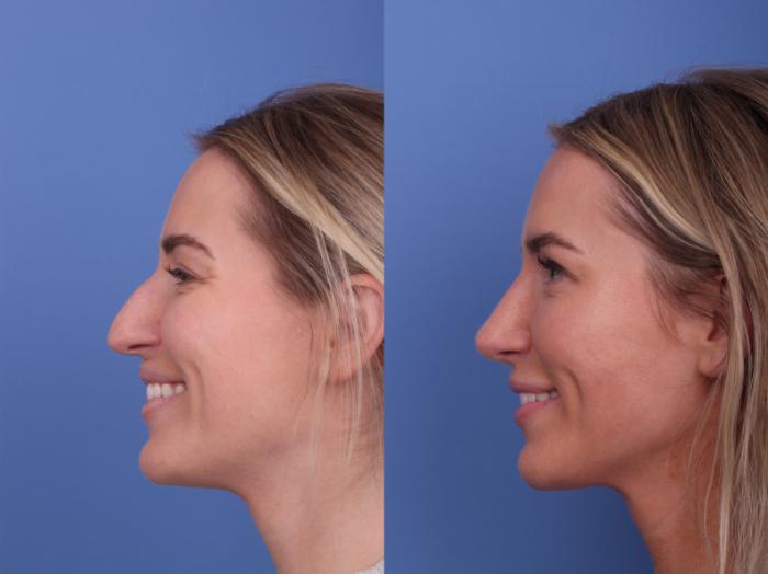 Rhinoplasty Before & After Photo | Scottsdale & Phoenix, AZ | Hobgood Facial Plastic Surgery: Todd Hobgood, MD