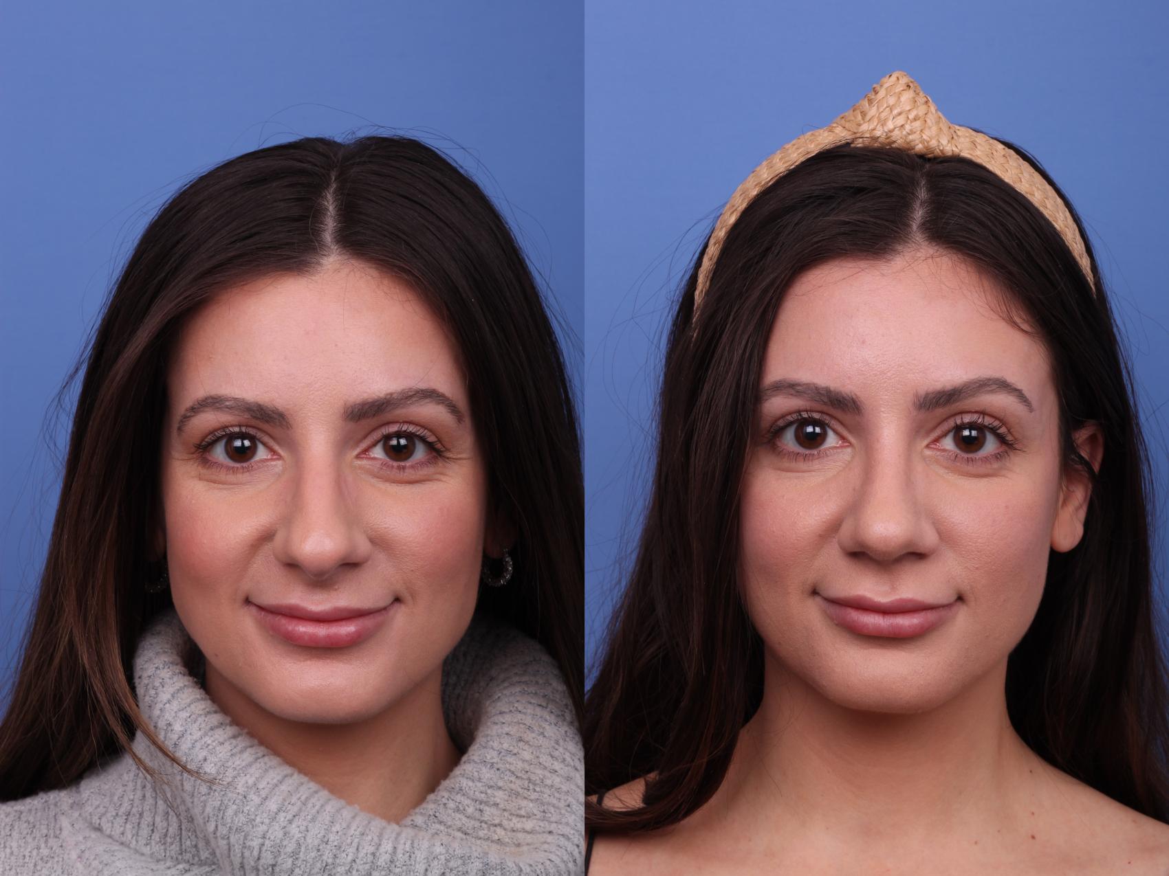 Rhinoplasty Before & After Photo | Scottsdale & Phoenix, AZ | Hobgood Facial Plastic Surgery: Todd Hobgood, MD