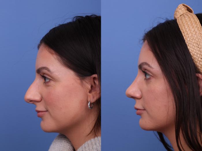 Rhinoplasty Before & After Photo | Scottsdale & Phoenix, AZ | Hobgood Facial Plastic Surgery: Todd Hobgood, MD