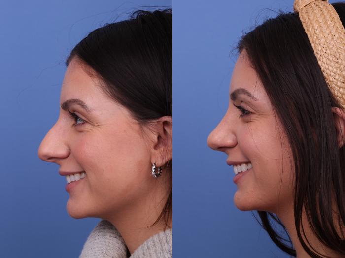 Rhinoplasty Before & After Photo | Scottsdale & Phoenix, AZ | Hobgood Facial Plastic Surgery: Todd Hobgood, MD