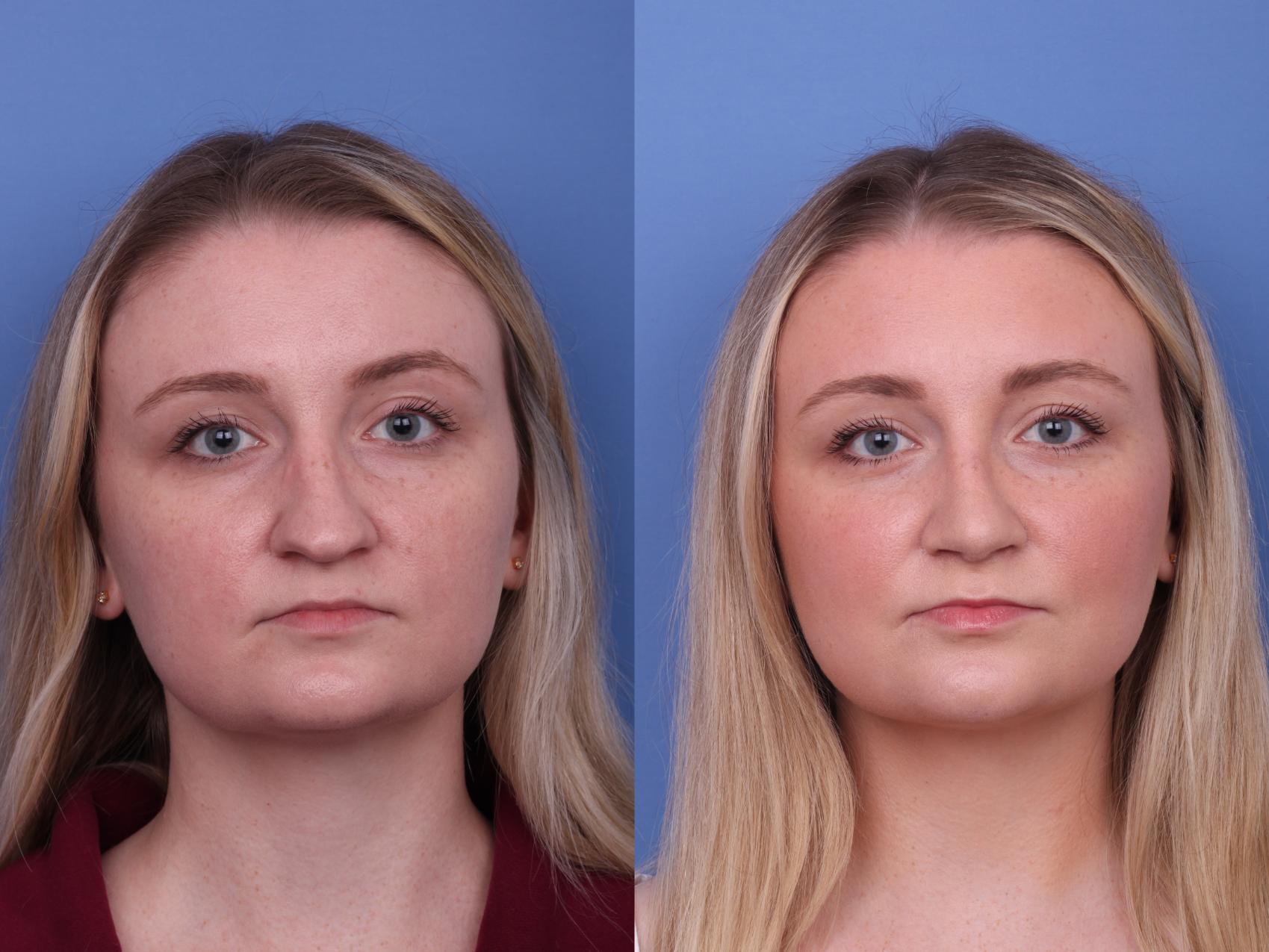Before & After Rhinoplasty Case 584 Front View in Scottsdale, AZ