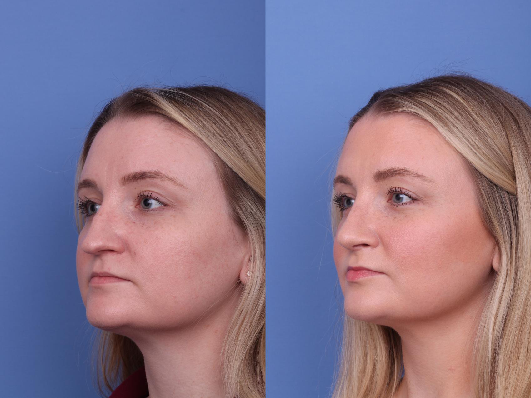 Rhinoplasty Before & After Photo | Scottsdale & Phoenix, AZ | Hobgood Facial Plastic Surgery: Todd Hobgood, MD