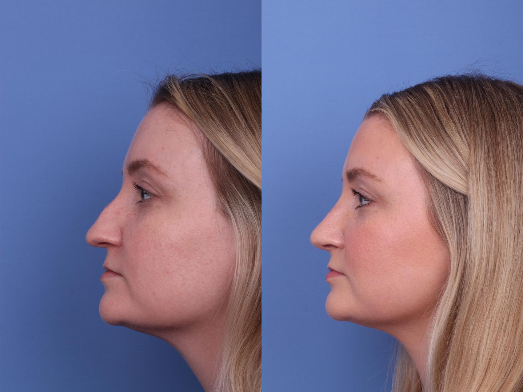 Before & After Rhinoplasty Case 584 Left Side View in Scottsdale, AZ