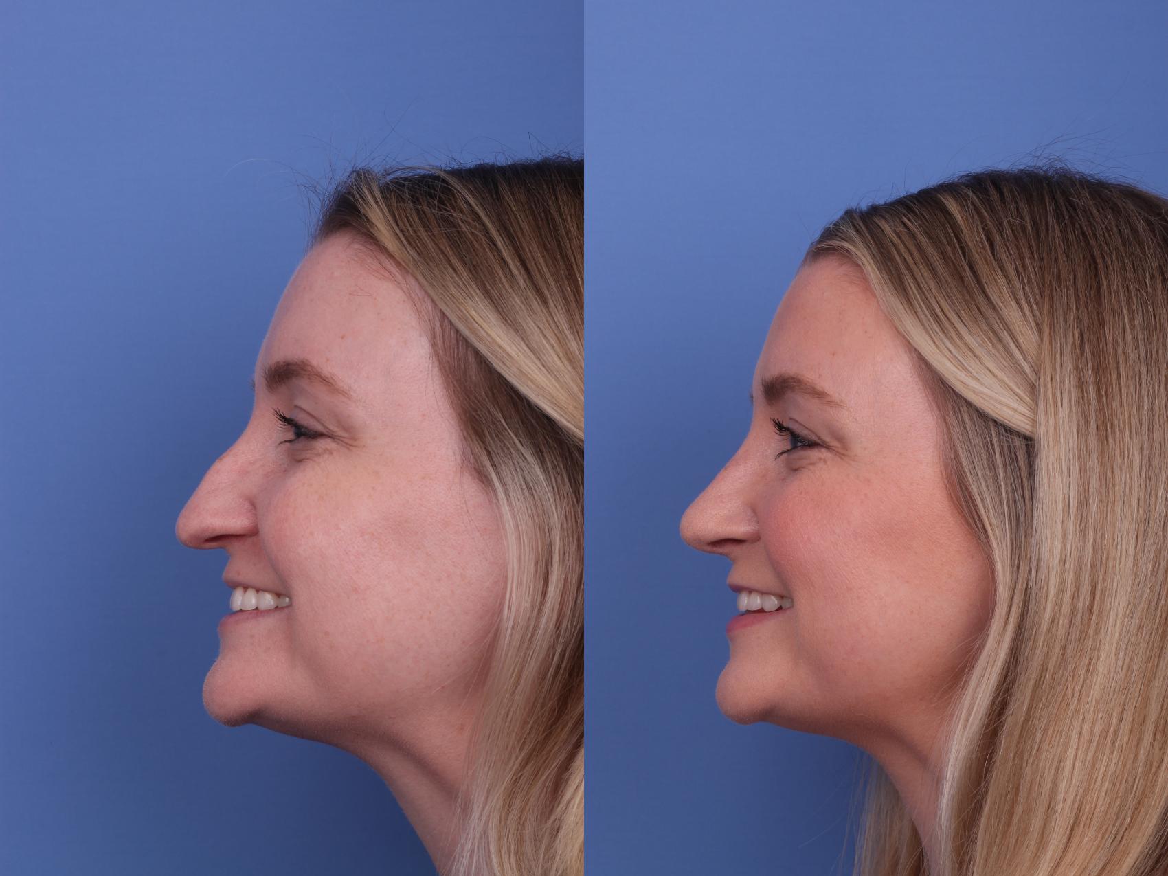 Before & After Rhinoplasty Case 584 Left Smile View in Scottsdale, AZ