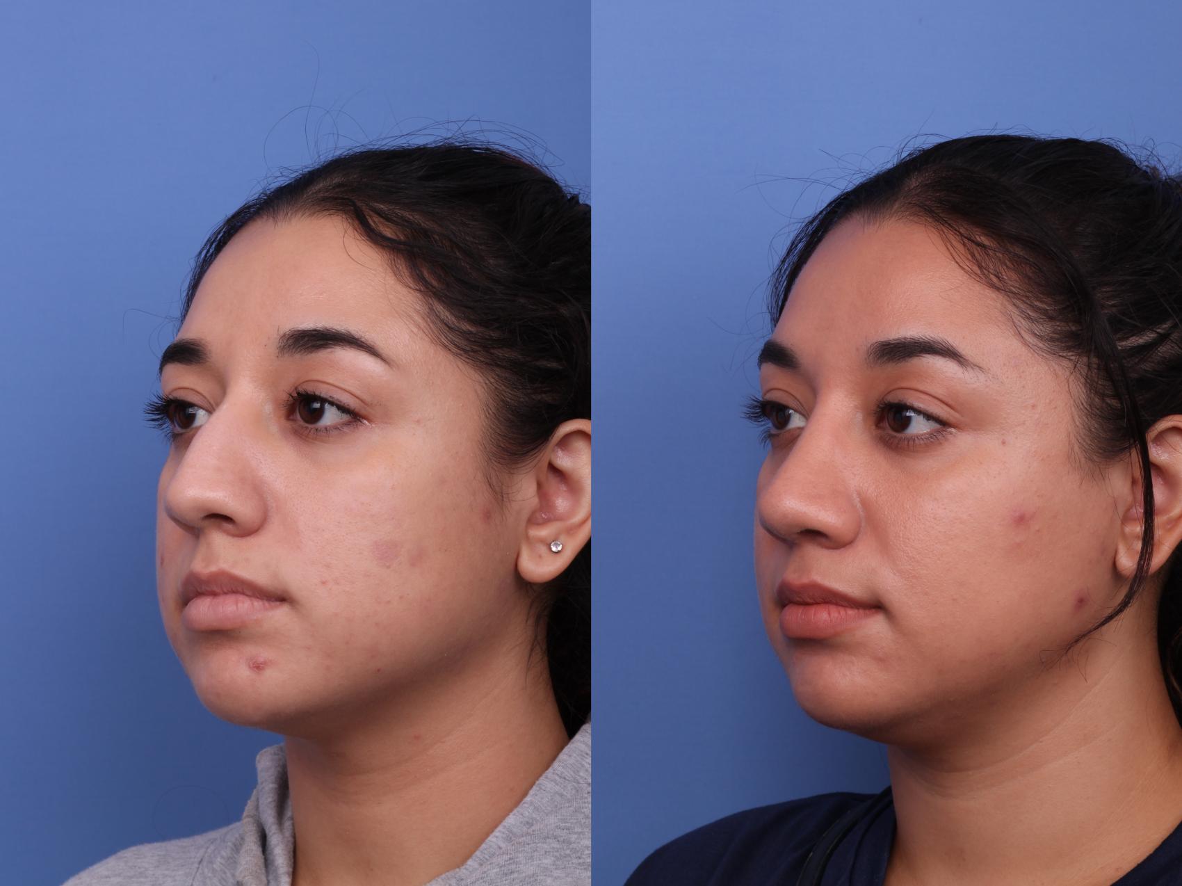 Before & After Rhinoplasty Case 585 Left Oblique View in Scottsdale, AZ