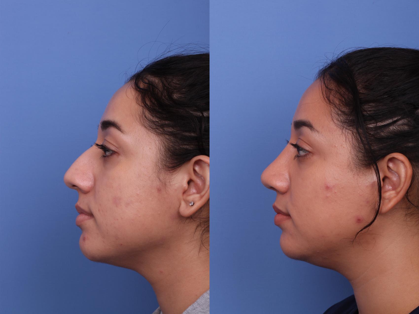 Rhinoplasty Before & After Photo | Scottsdale & Phoenix, AZ | Hobgood Facial Plastic Surgery: Todd Hobgood, MD