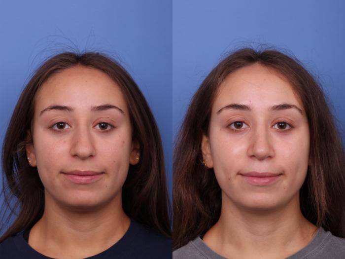 Rhinoplasty Before & After Photo | Scottsdale & Phoenix, AZ | Hobgood Facial Plastic Surgery: Todd Hobgood, MD