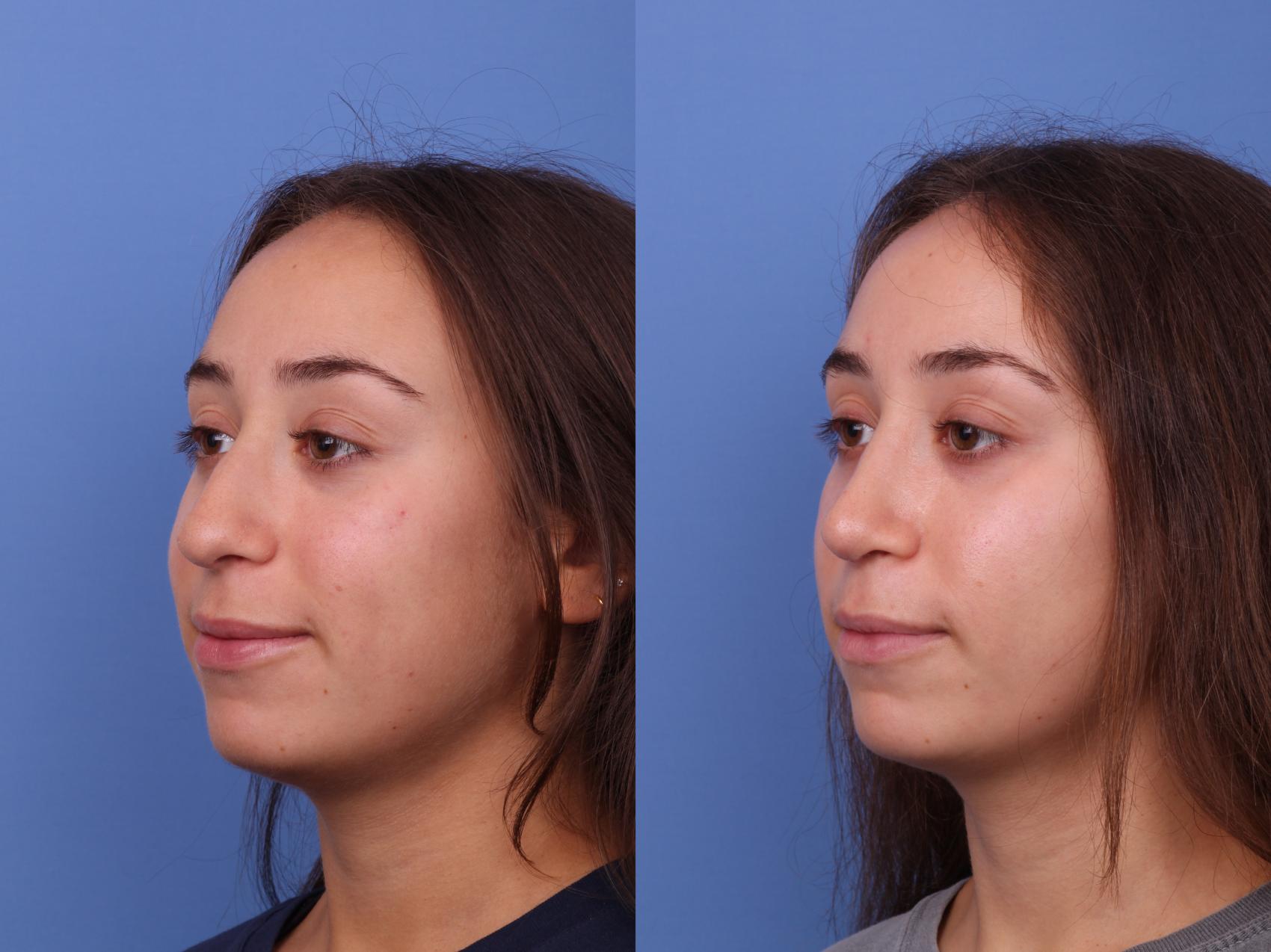 Before & After Rhinoplasty Case 587 Left Oblique View in Scottsdale, AZ