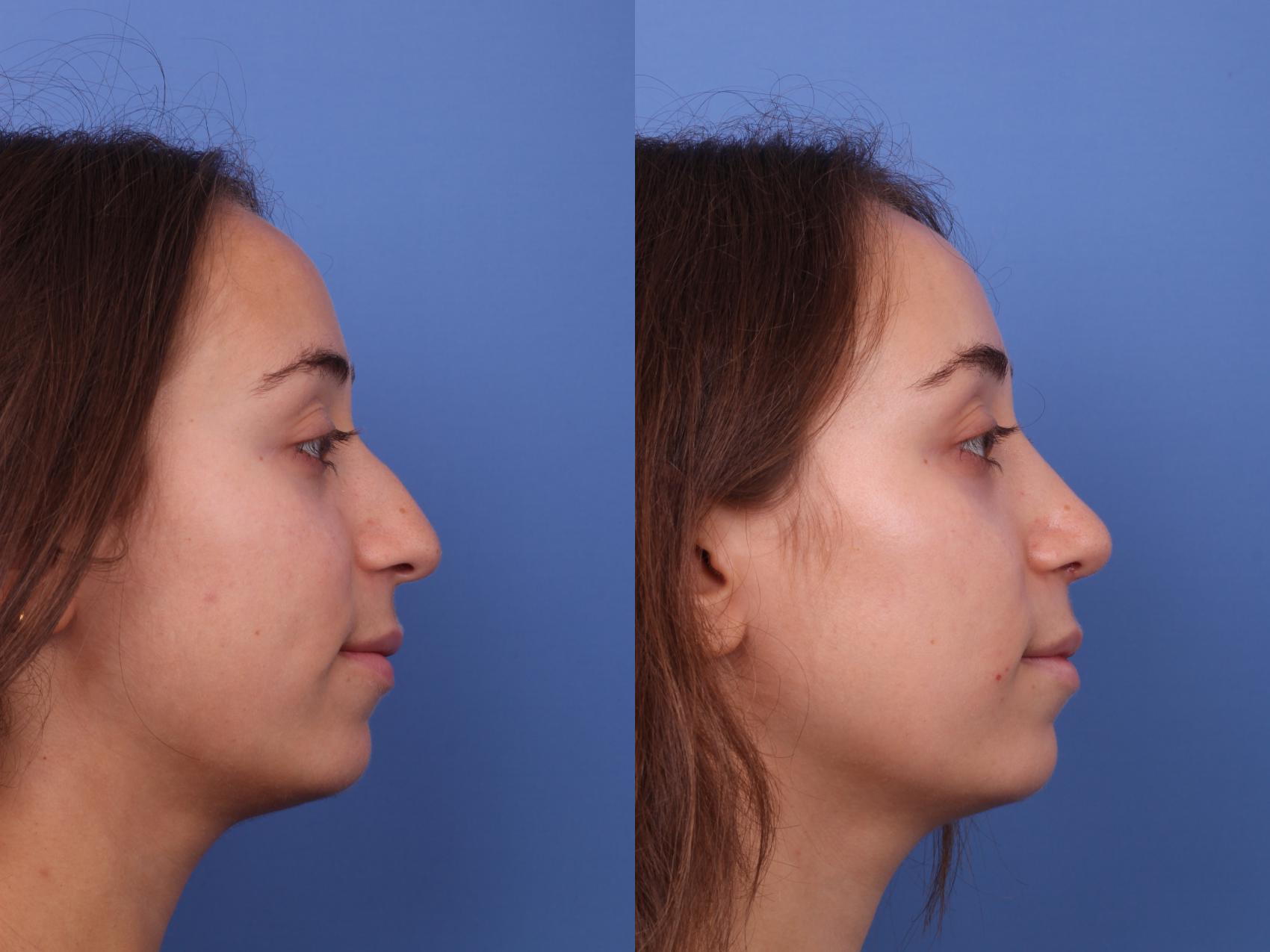 Before & After Rhinoplasty Case 587 Right Side View in Scottsdale, AZ