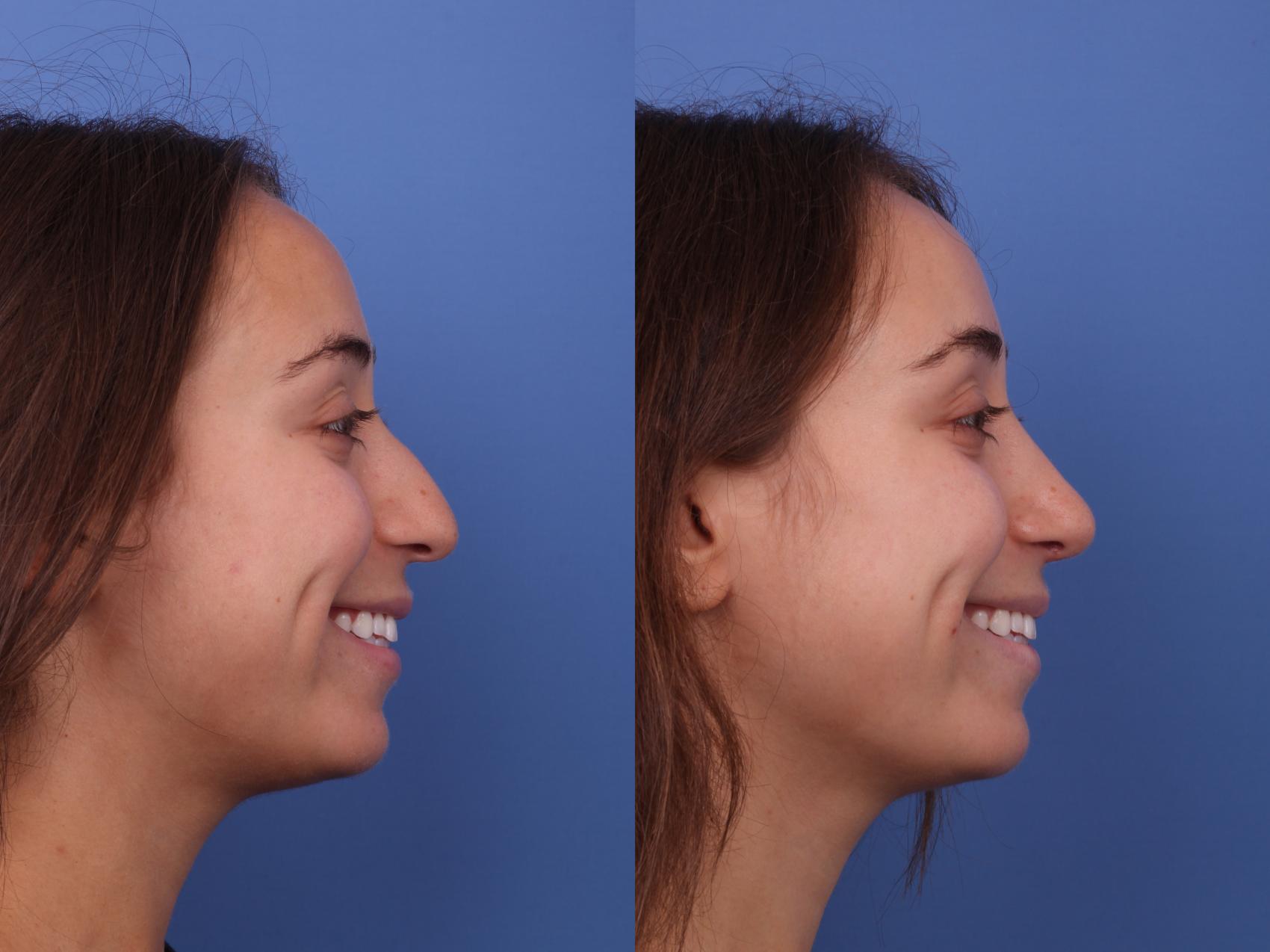 Before & After Rhinoplasty Case 587 Right Smile View in Scottsdale, AZ