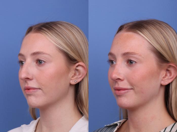 Rhinoplasty Before & After Photo | Scottsdale & Phoenix, AZ | Hobgood Facial Plastic Surgery: Todd Hobgood, MD