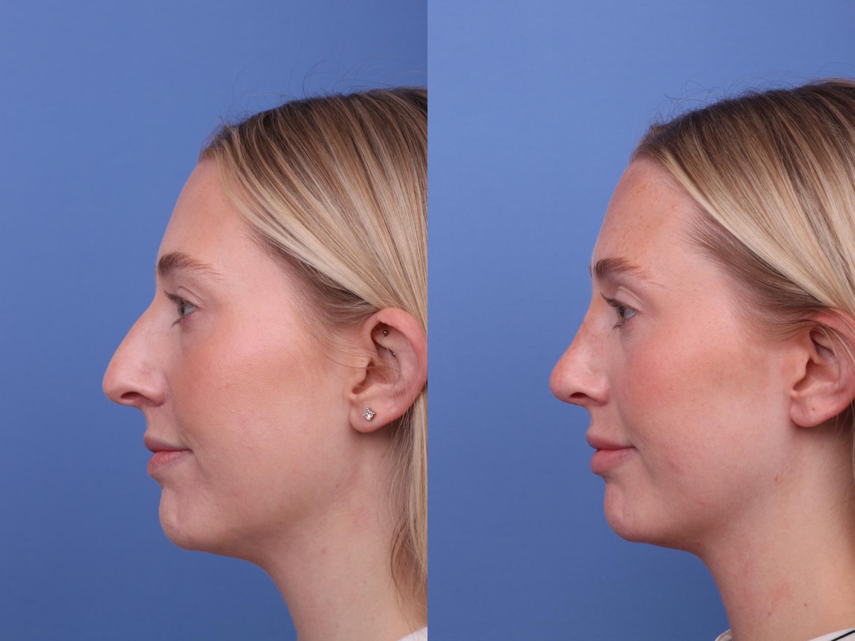 Before & After Rhinoplasty Case 588 Left Side View in Scottsdale, AZ