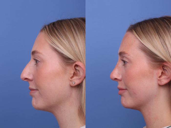 Rhinoplasty Before & After Photo | Scottsdale & Phoenix, AZ | Hobgood Facial Plastic Surgery: Todd Hobgood, MD