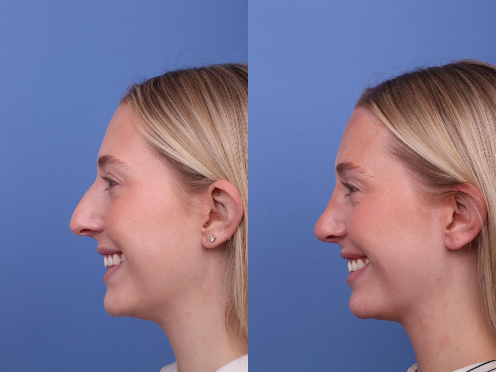 Before & After Rhinoplasty Case 588 Left Smile View in Scottsdale, AZ