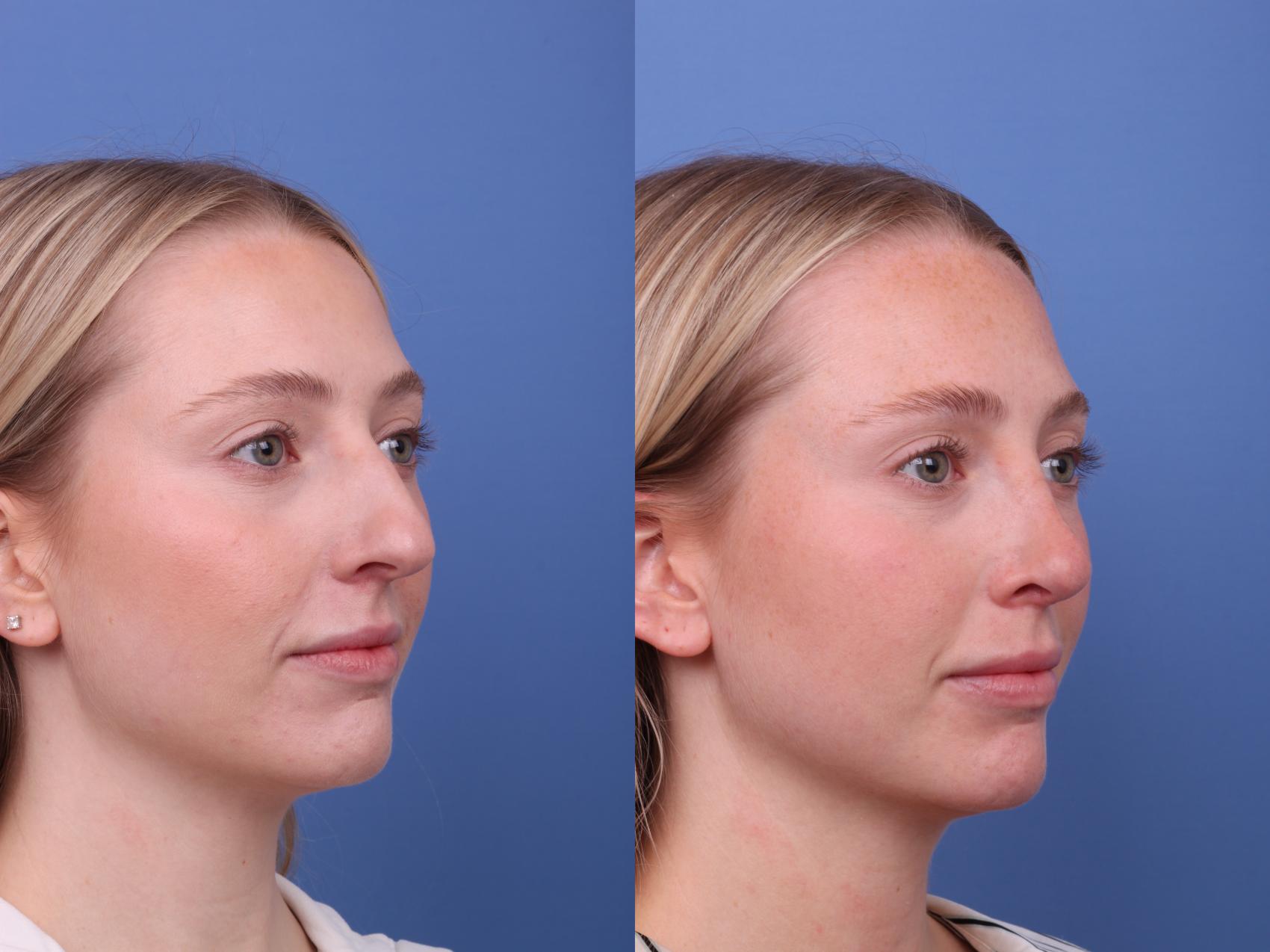 Before & After Rhinoplasty Case 588 Right Oblique View in Scottsdale, AZ