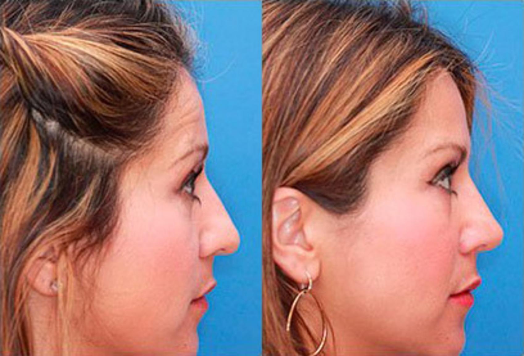 Before & After Rhinoplasty Case 59 View #2 View in Scottsdale, AZ