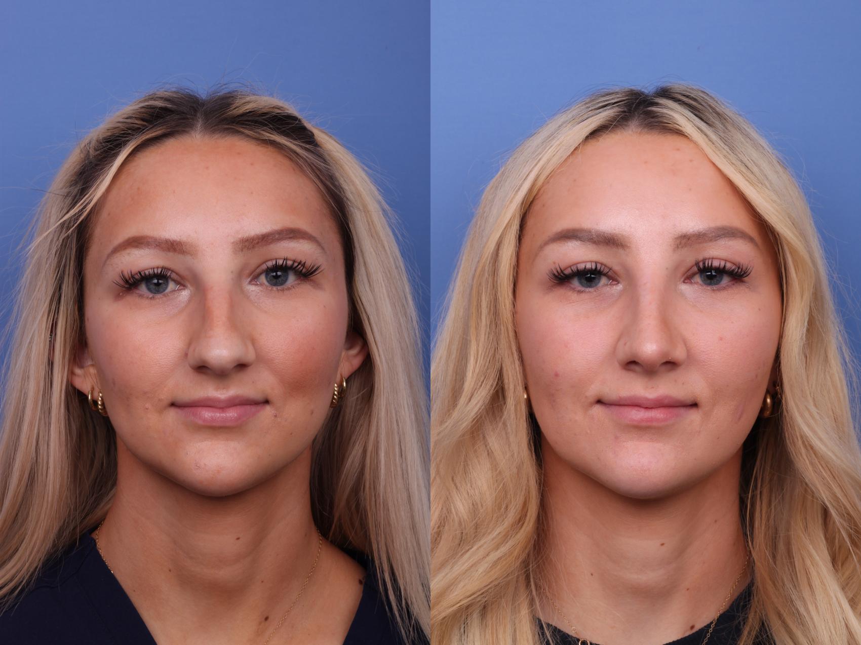 Rhinoplasty Before & After Photo | Scottsdale & Phoenix, AZ | Hobgood Facial Plastic Surgery: Todd Hobgood, MD