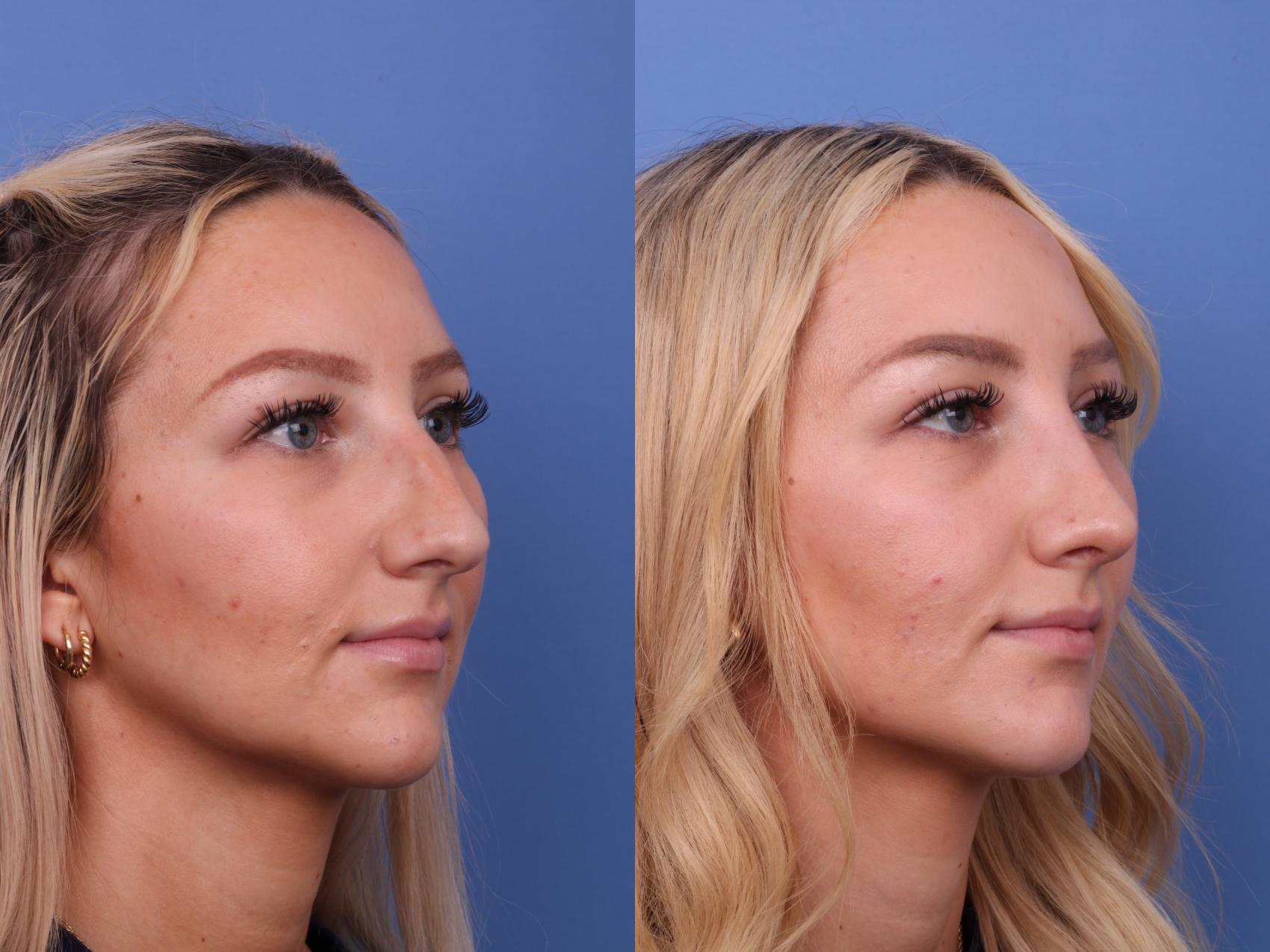 Before & After Rhinoplasty Case 590 Right Oblique View in Scottsdale, AZ
