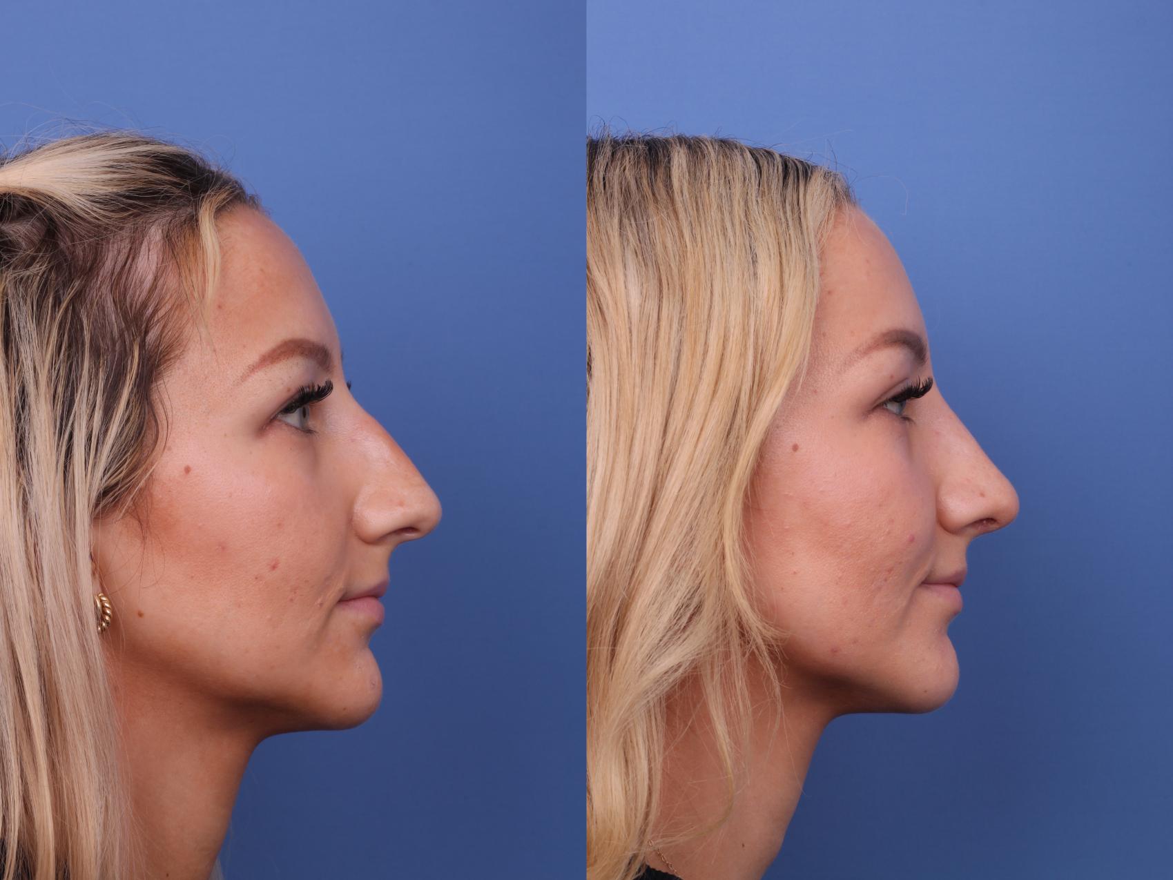 Before & After Rhinoplasty Case 590 Right Side View in Scottsdale, AZ