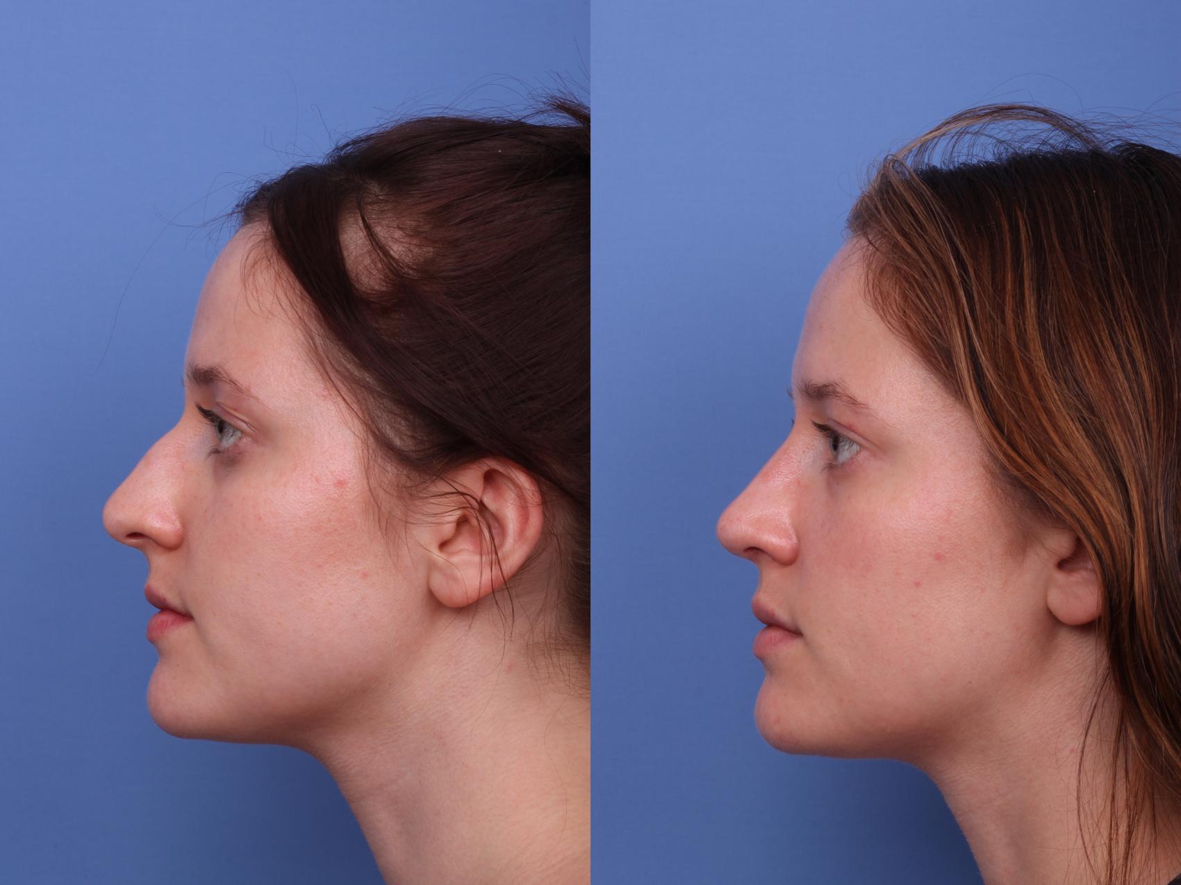 Rhinoplasty Before & After Photo | Scottsdale & Phoenix, AZ | Hobgood Facial Plastic Surgery: Todd Hobgood, MD