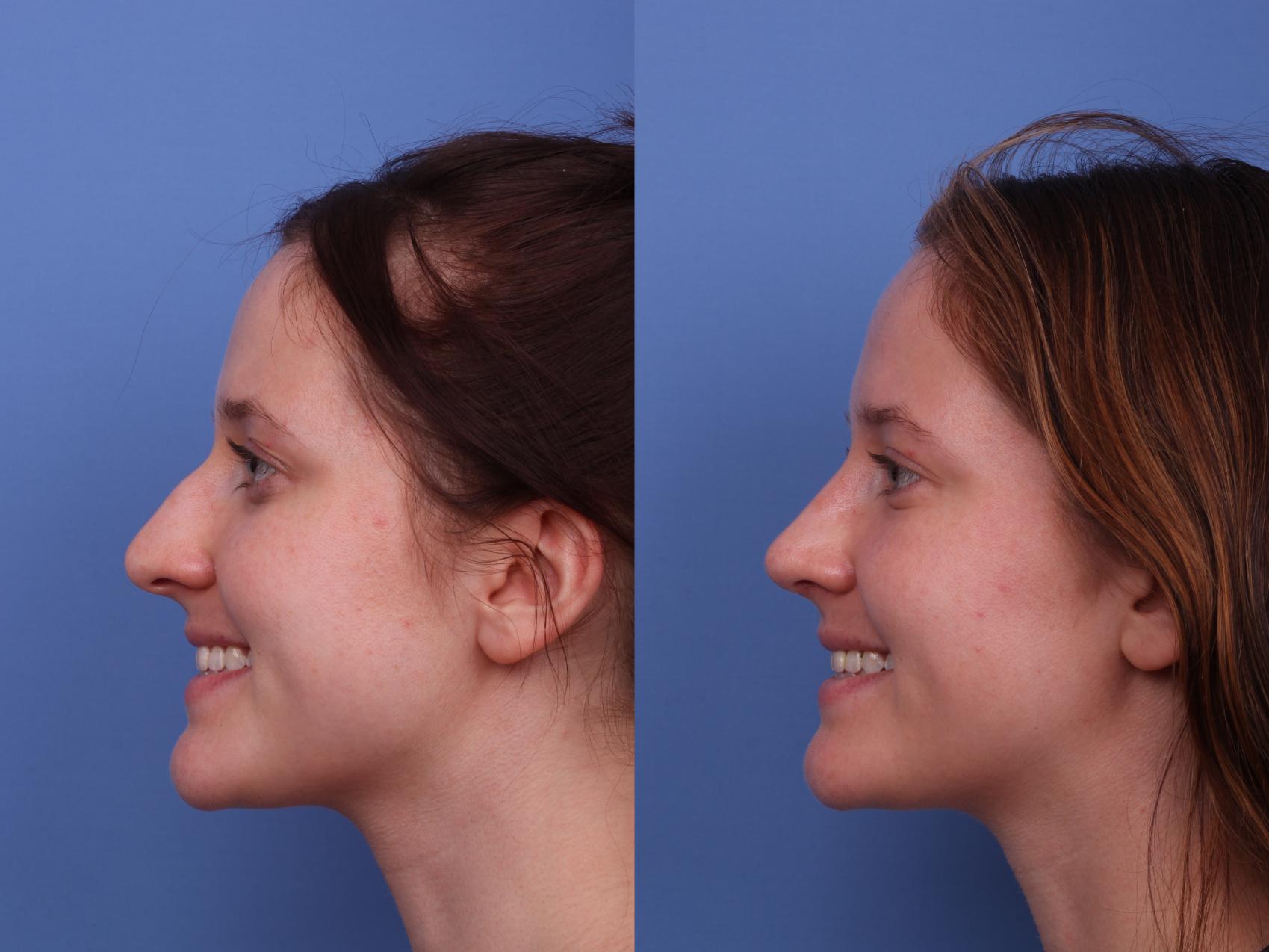 Before & After Rhinoplasty Case 593 Left Smile View in Scottsdale, AZ