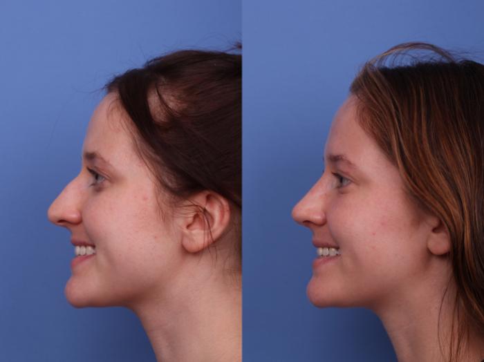 Rhinoplasty Before & After Photo | Scottsdale & Phoenix, AZ | Hobgood Facial Plastic Surgery: Todd Hobgood, MD