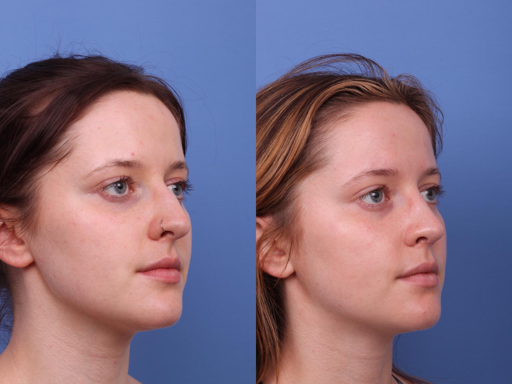 Before & After Rhinoplasty Case 593 Right Oblique View in Scottsdale, AZ
